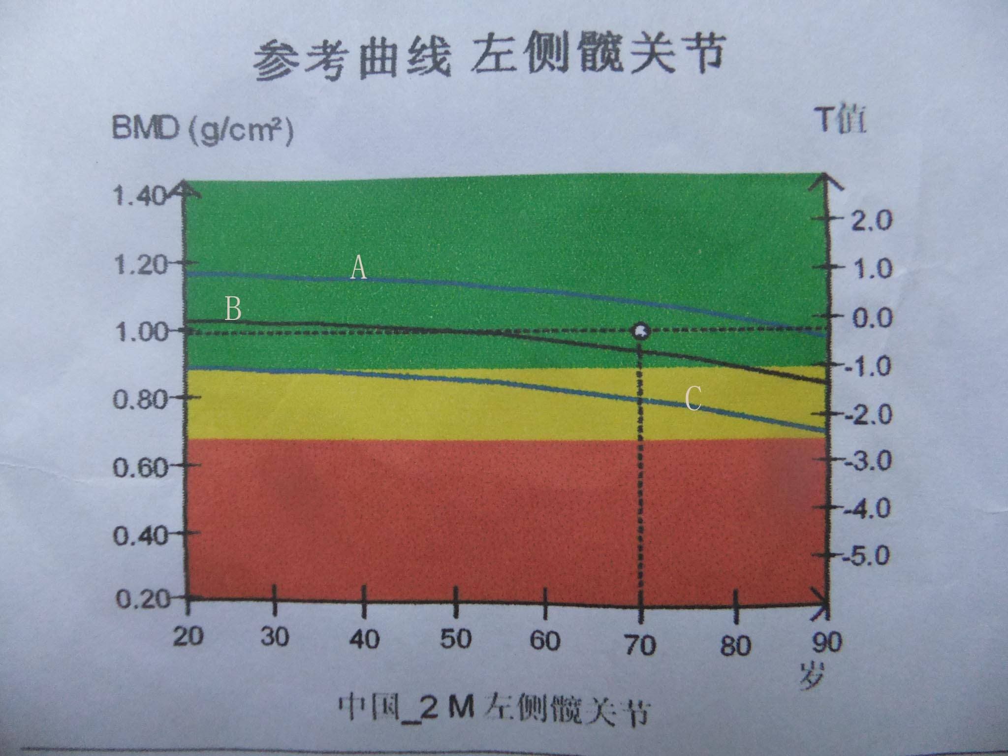 骨密度檢測報告中T值和Z值是啥意思